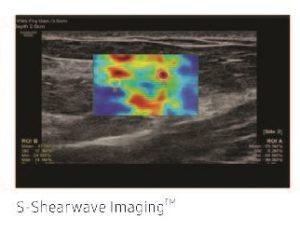 sonography-rs85